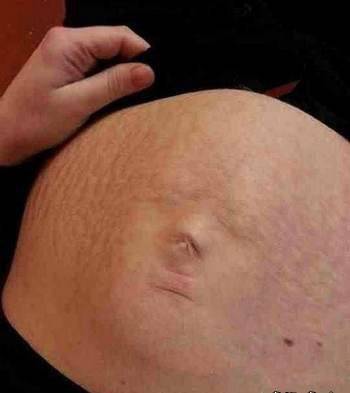 孕妇肚皮上惊现一张婴儿脸