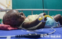 惊人！印度男婴无故自燃，医生也束手无策