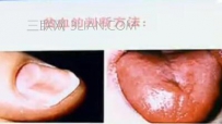 贫血有什么症状