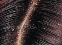 头皮屑怎么去除小窍门