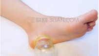 拔火罐的误区有哪些