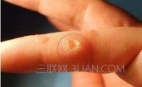 鱼痣是什么？鱼痣的治疗方法