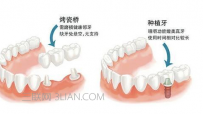 镶牙有什么坏处