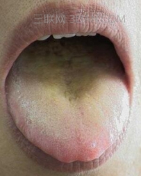 舌苔发黄是什么原因