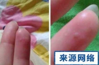 手上起小水泡痒 手上起小水泡很痒是怎么回事