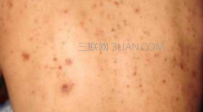 后背长痘痘要注意些什么