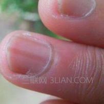 手指甲上有竖纹是怎么回事