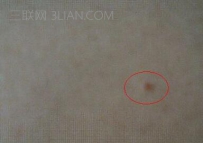 身上长红痣是什么原因