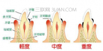 哪些偏方能治牙周炎