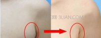 如何预防副乳