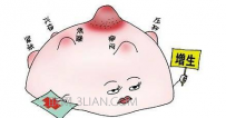 小叶增生疼能热敷吗