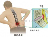 什么是腰肌劳损