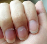 指甲上有白斑是怎么回事