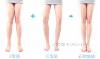 X型腿O型腿怎么矫正