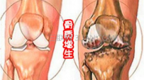 如何治疗骨质增生