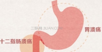 胃溃疡有什么症状