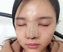 耳软骨垫鼻尖 关于鼻子的整形我都有亲身经历