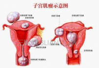 子宫肌瘤如何检查出来