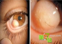 世界十大恐怖眼球：双瞳孔眼绝世罕见