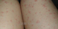 荨麻疹的治疗需要注意什么