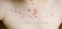 患上红斑狼疮的原因是什么