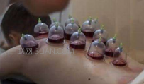 拔火罐后的颜色说明什么