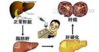 脂肪肝该如何治疗