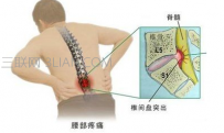 腰椎间盘突出怎么治疗