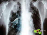 人体发生的诡异事件：体内不断长出铁丝