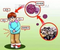诺如病毒症状