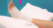 扭伤后要如何处理