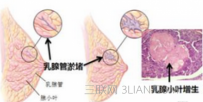 小叶增生有哪些症状