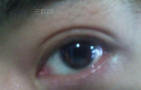 如何从眼睛分泌物看出眼部疾病
