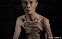 一位日本原子弹爆炸幸存者的披露：变形的身体警诫后人