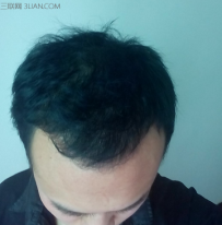 什么是脂溢性脱发