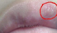 嘴角起泡是咋回事