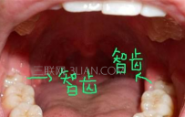 智齿肿痛怎么办