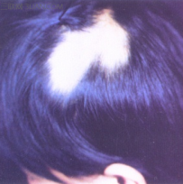 斑秃能治好吗
