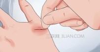 如何判断伤口是否发炎