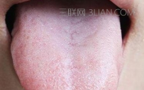 舌苔发白能治吗