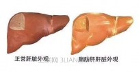 脂肪肝是怎么回事