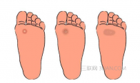 鸡眼怎么能彻底根治