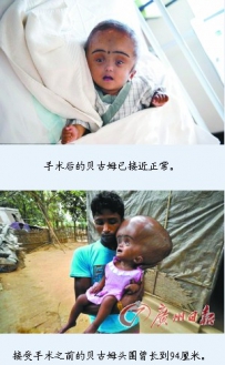 印度“大头娃娃”成功“缩头”近半