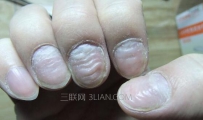 手指甲凹凸不平有什么危害