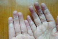 手脚脱皮是什么原因