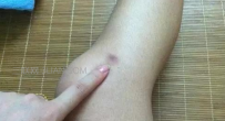 淤青颜色为什么会变化