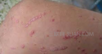 银屑病要如何止痒