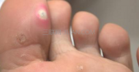 脚底长鸡眼怎么回事