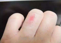 开水烫伤一般多久能好