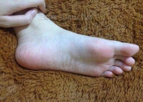 脚上起水泡怎么办